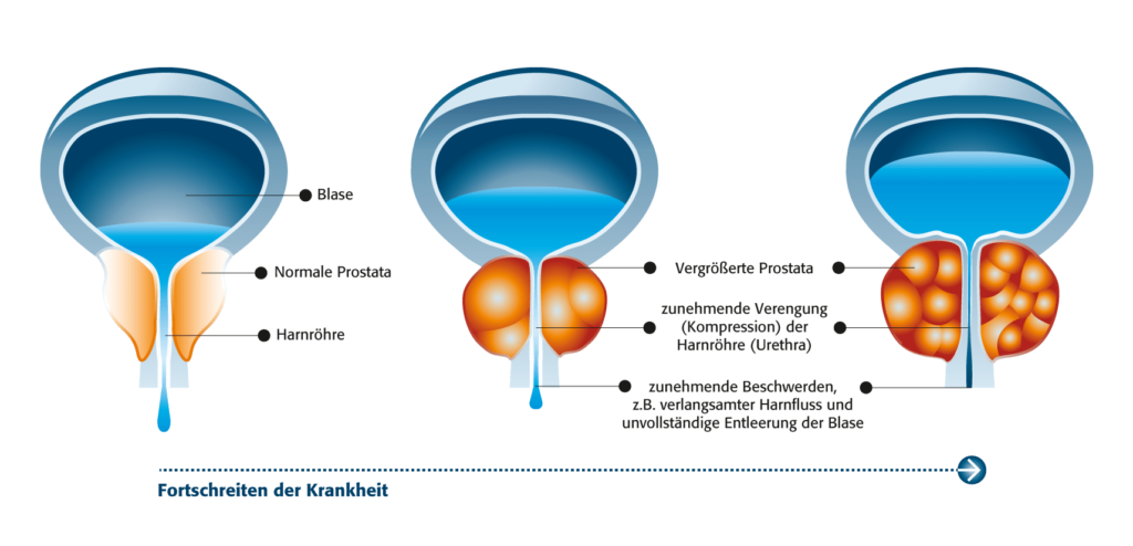 Prostatahyperplasie Symptome And Behandlung Granufink® 